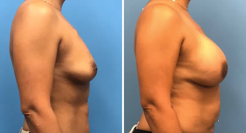 Before and after breast reconstruction: woman's breasts from the right side