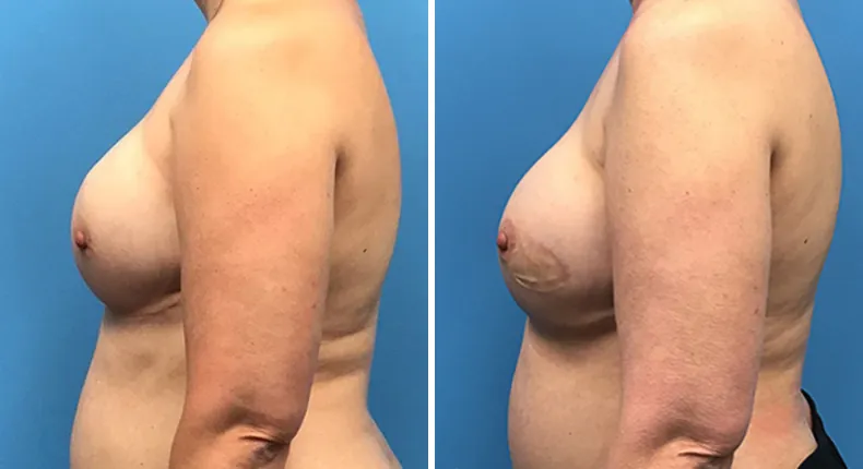 Before and after breast reconstruction: woman's breasts from the left side