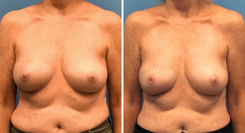 Before and after breast reconstruction: woman's breasts from the front