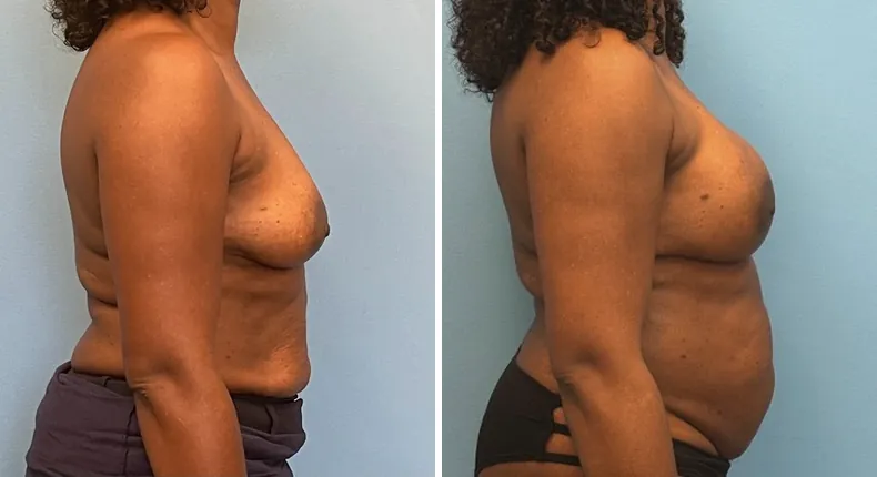 Before and after breast reconstruction: patient's breasts from the right side