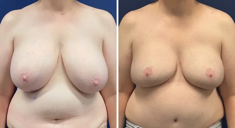 Before and after breast reconstruction: patient's breasts from the front, with diep flap