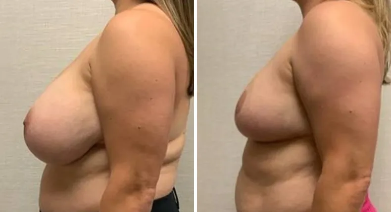 Before and after breast reconstruction: patient's breasts from the left side