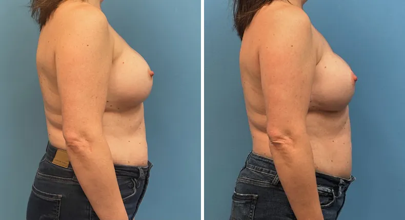 Before and after breast reconstruction: patient's breasts from the right side