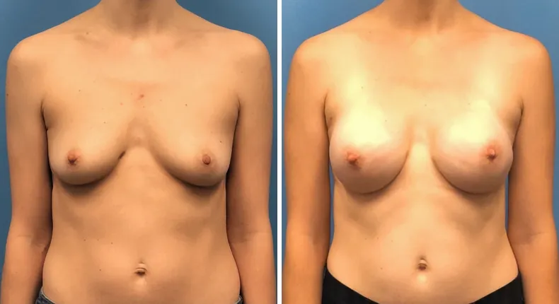 Before and after breast reconstruction: patient's breasts from the front