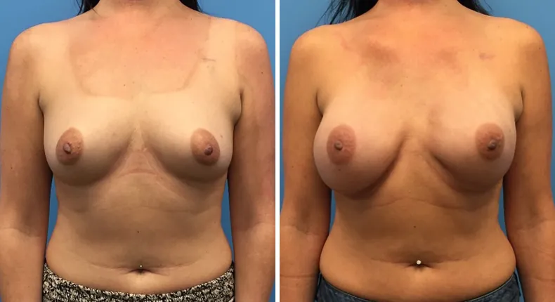 Before and after breast reconstruction: woman's breasts