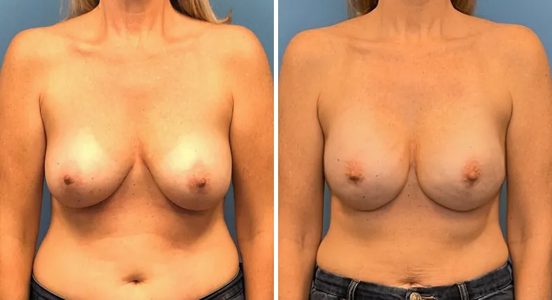 Before and after breast reconstruction: patient's breasts