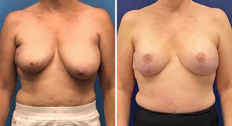 Before and after breast reconstruction: patient's breasts from the front