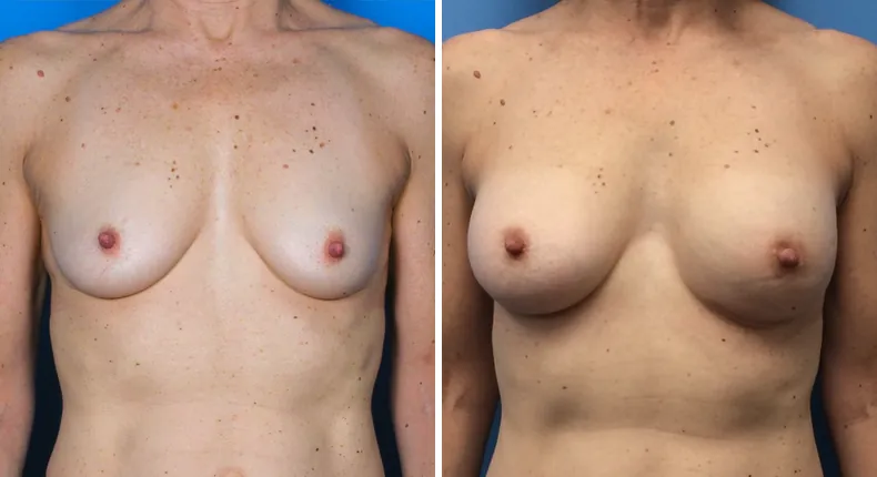 Before and after breast reconstruction: patient's breasts