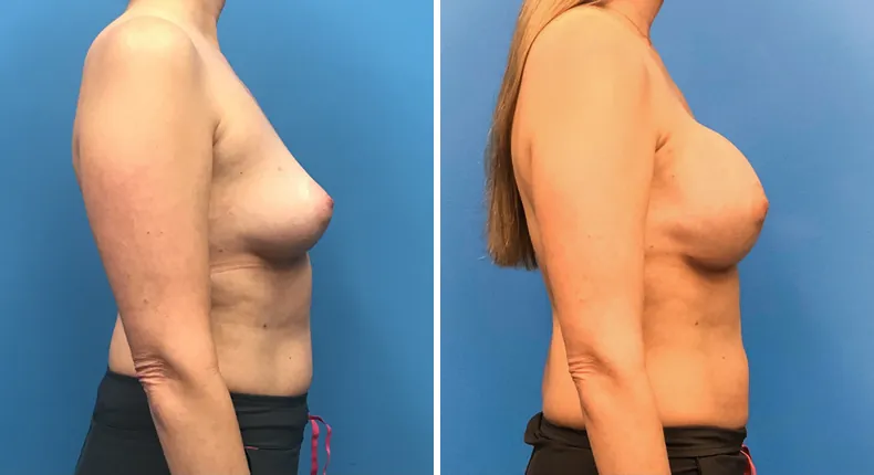 Before and after breast reconstruction: woman's breasts from the right side