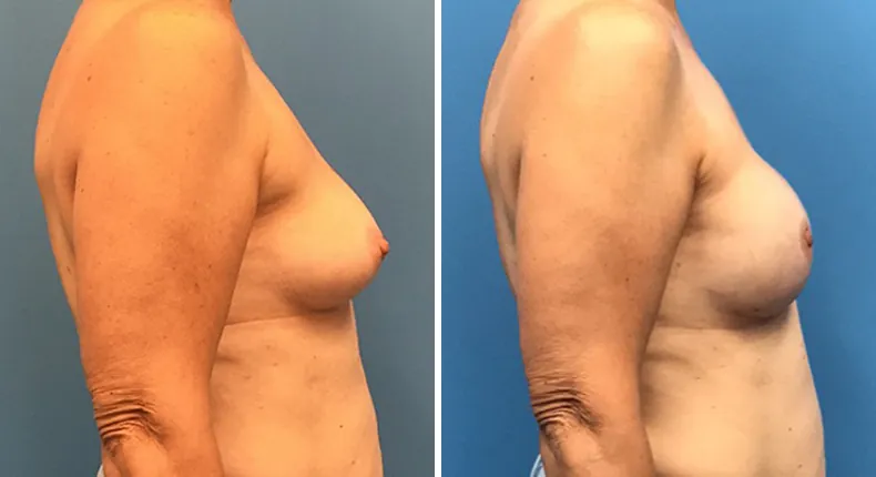 Before and after breast reconstruction: woman's breasts from the right side