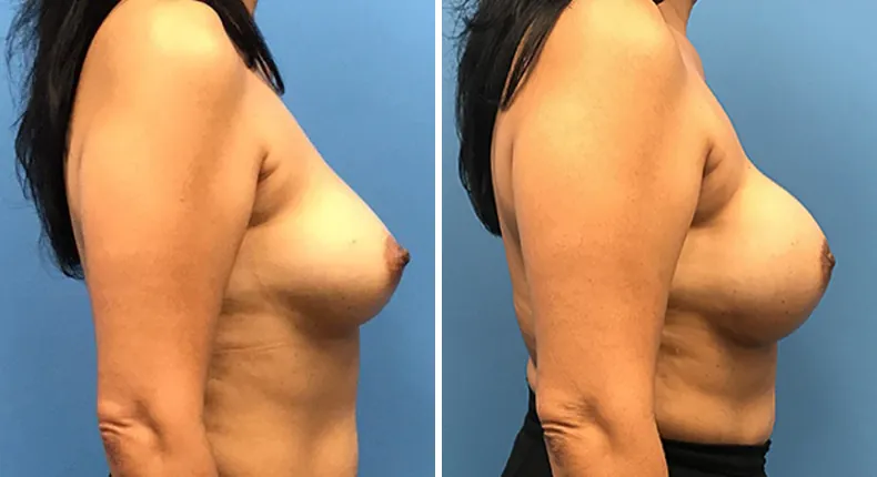 Before and after breast reconstruction: woman's breasts from the right side