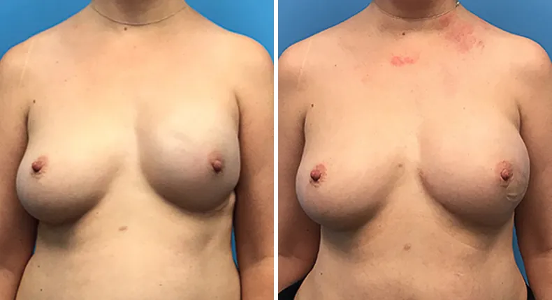 Before and after breast reconstruction: woman's breasts from the front