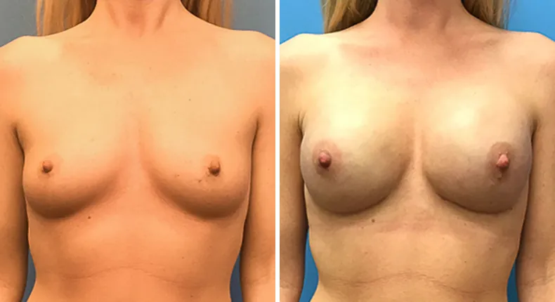 Before and after breast reconstruction: woman's breasts from the front