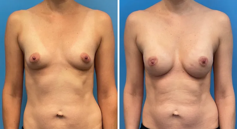 Before and after breast reconstruction: patient's breasts from the front