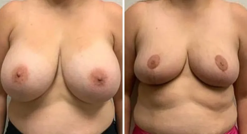 Before and after breast reconstruction: patient's breasts from the front