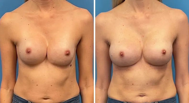 Before and after breast reconstruction: patient's breasts