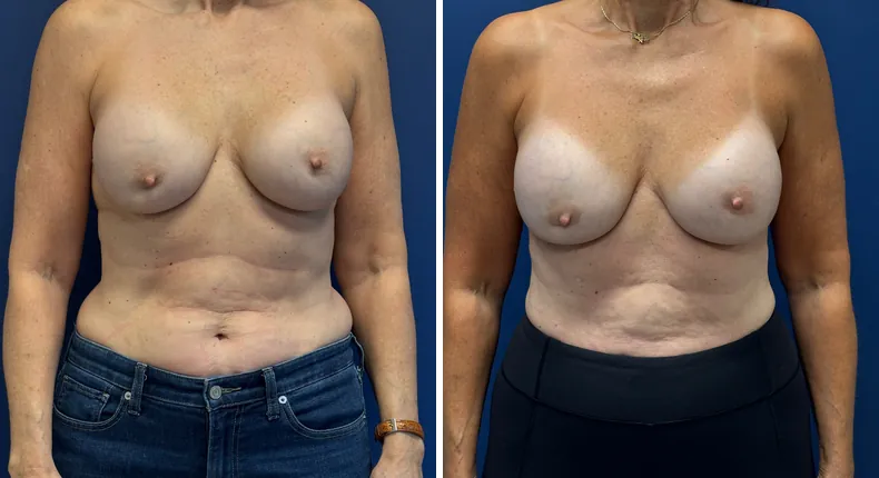 Before and after breast reconstruction: patient's breasts