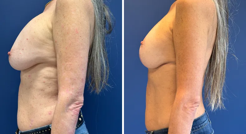 Before and after breast reconstruction: patient's breasts in left profile