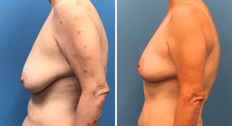 Before and after breast reconstruction: woman's breasts from the left side
