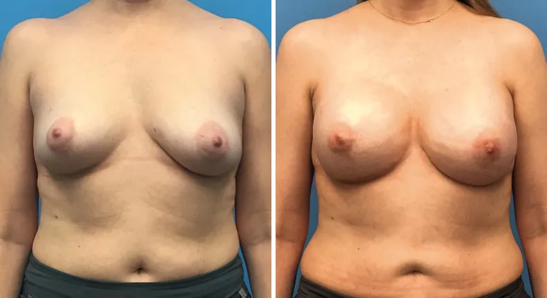 Before and after breast reconstruction: woman's breasts