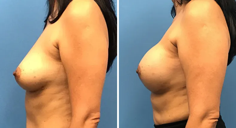Before and after breast reconstruction: woman's breasts from the left side