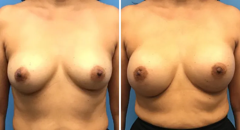Before and after breast reconstruction: woman's breasts from the front