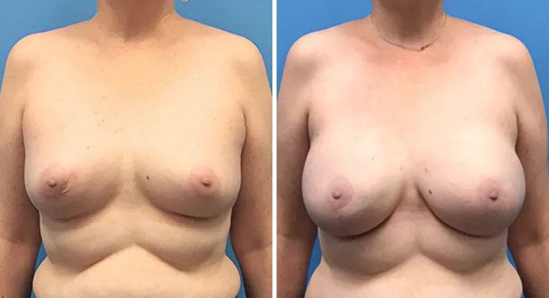 Before and after breast reconstruction: woman's breasts from the front