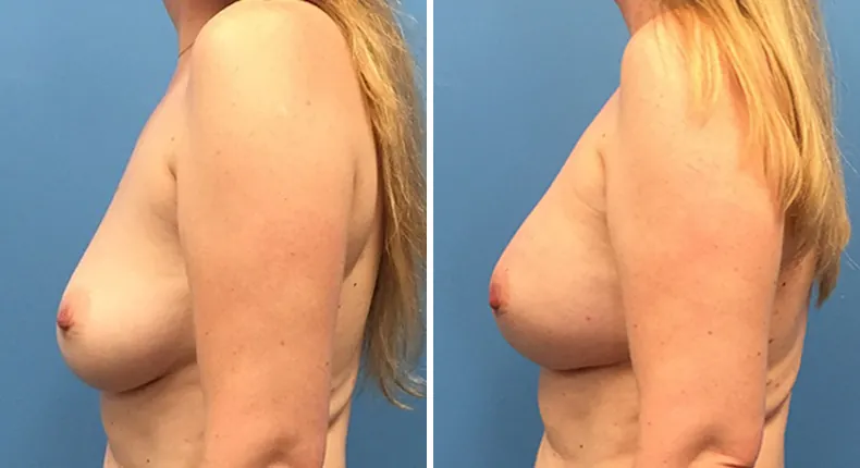 Before and after breast reconstruction: woman's breasts from the left side