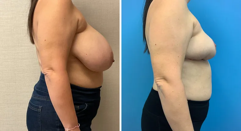 Before and after breast reconstruction: patient's breasts in right profile