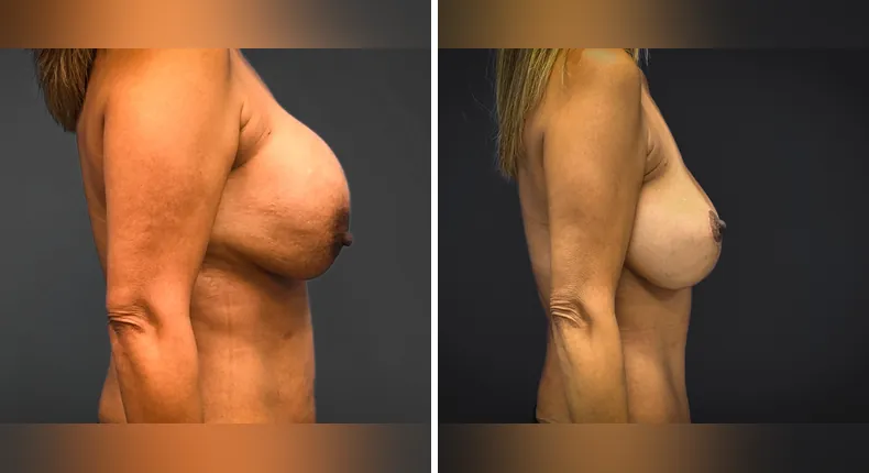Before and after breast reconstruction: patient's breasts from the right side