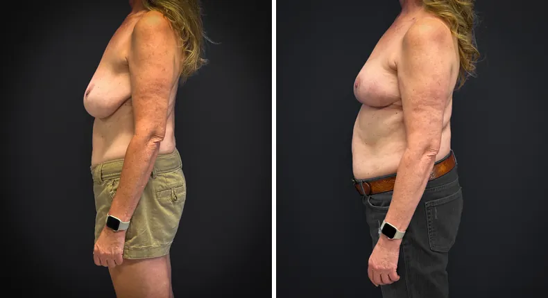 Before and after breast reconstruction: patient's breasts from the left side