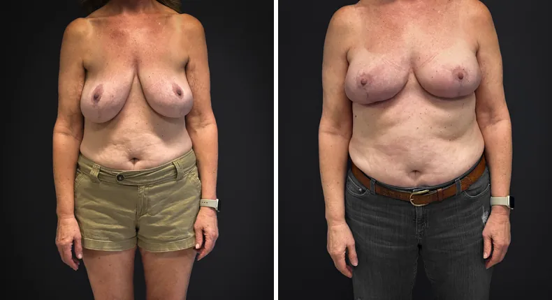 Before and after breast reconstruction: patient's breasts from the front