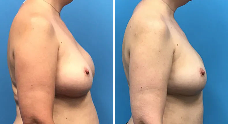 Before and after breast reconstruction: woman's breasts from the right side