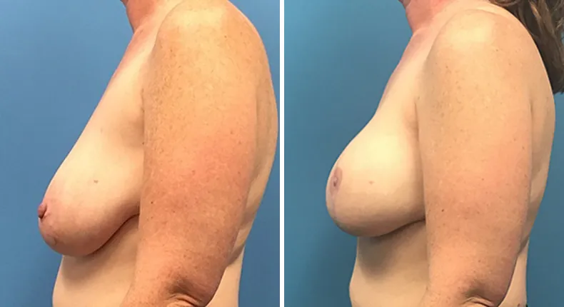 Before and after breast reconstruction: woman's breasts from the left side