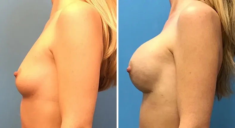 Before and after breast reconstruction: woman's breasts from the left side