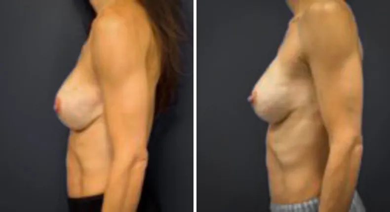 Before and after breast reconstruction: patient's breasts