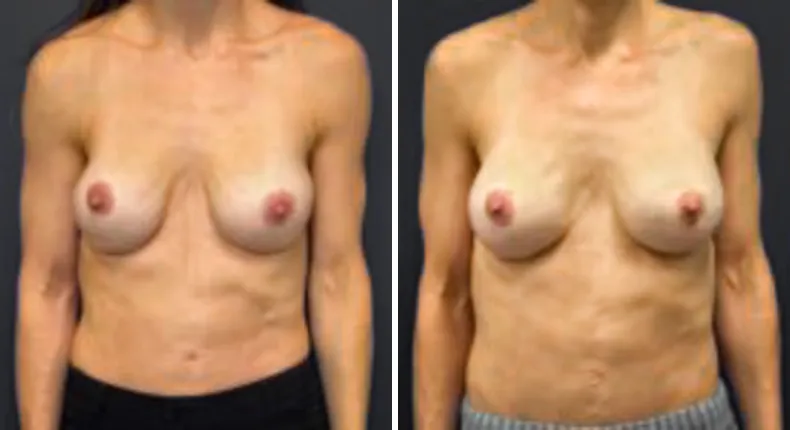 Before and after breast reconstruction: patient's breasts from the front