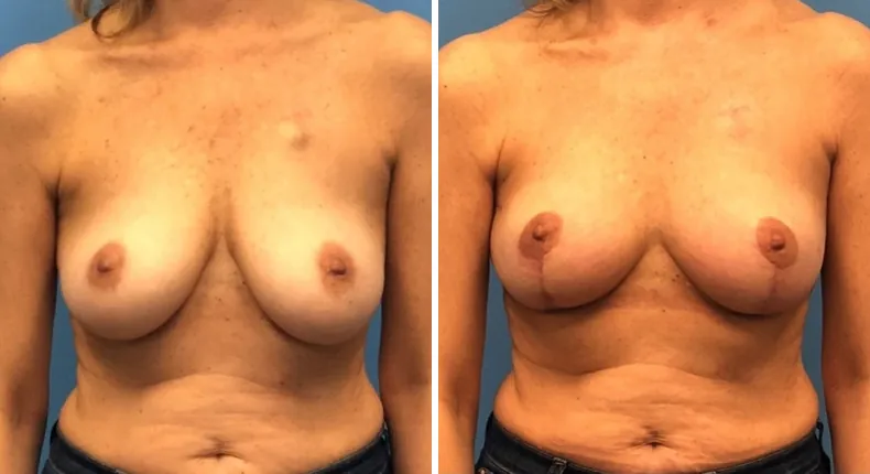 Before and after breast reconstruction: patient's breasts