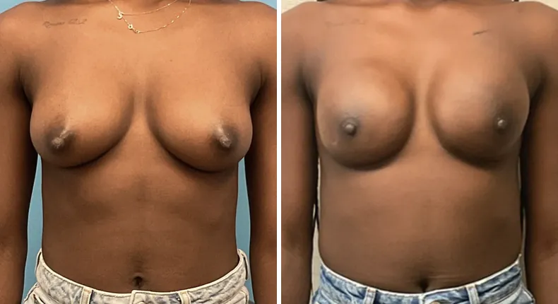 Before and after breast reconstruction: patient's breasts