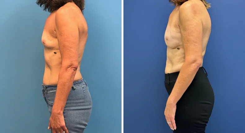 Before and after breast reconstruction: woman's breasts from the right side