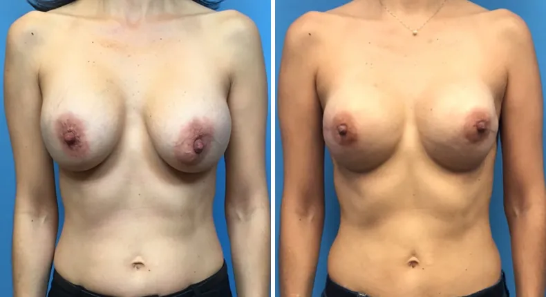 Before and after breast reconstruction: woman's breasts