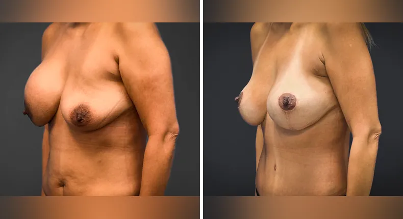 Before and after breast reconstruction: patient's breasts from the left side