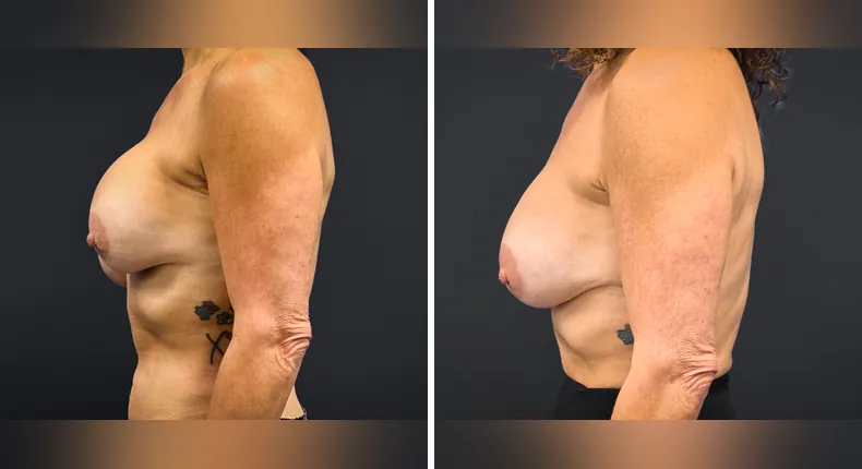 Before and after breast reconstruction: patient's breasts