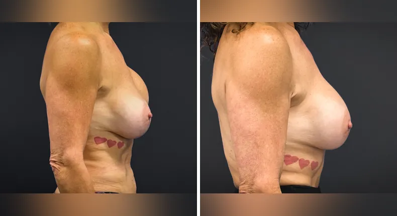 Before and after breast reconstruction: patient's breasts