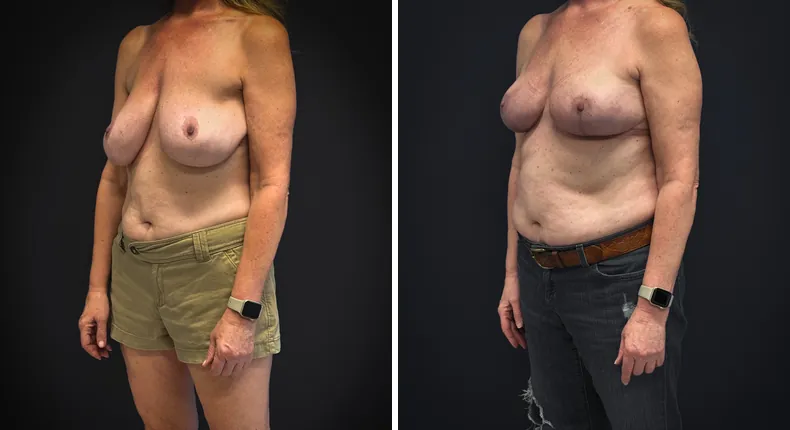 Before and after breast reconstruction: patient's breasts from the left side
