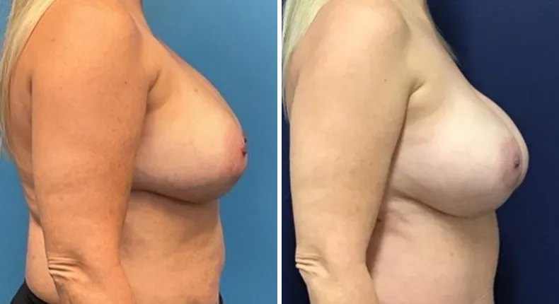 Before and after breast reconstruction: patient's breasts from the right side