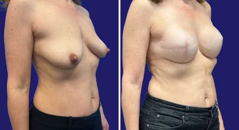 Before and after breast reconstruction: woman's breasts