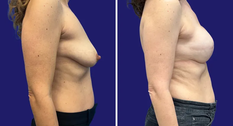Before and after breast reconstruction: woman's breasts