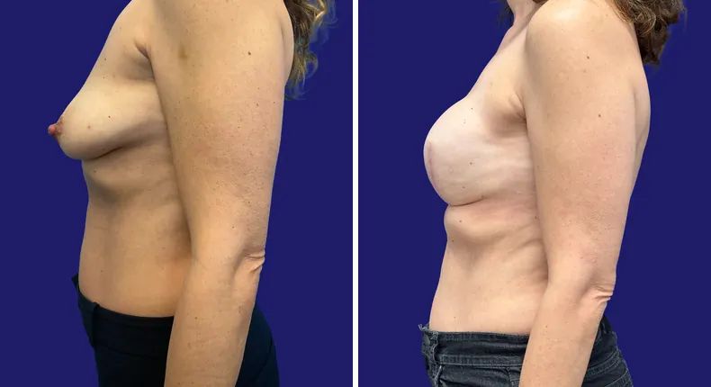 Before and after breast reconstruction: woman's breasts