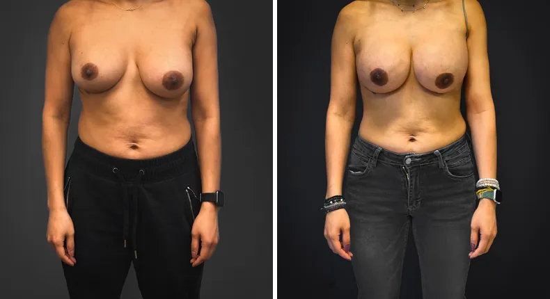 Before and after breast reconstruction: patient's breasts from the front